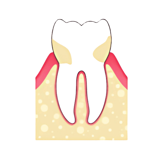 gingivitis