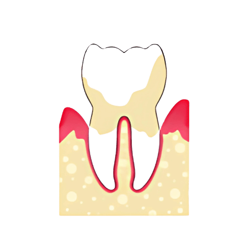 gingivitis avanzada