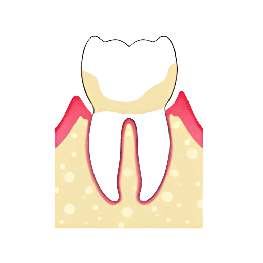periodontitis